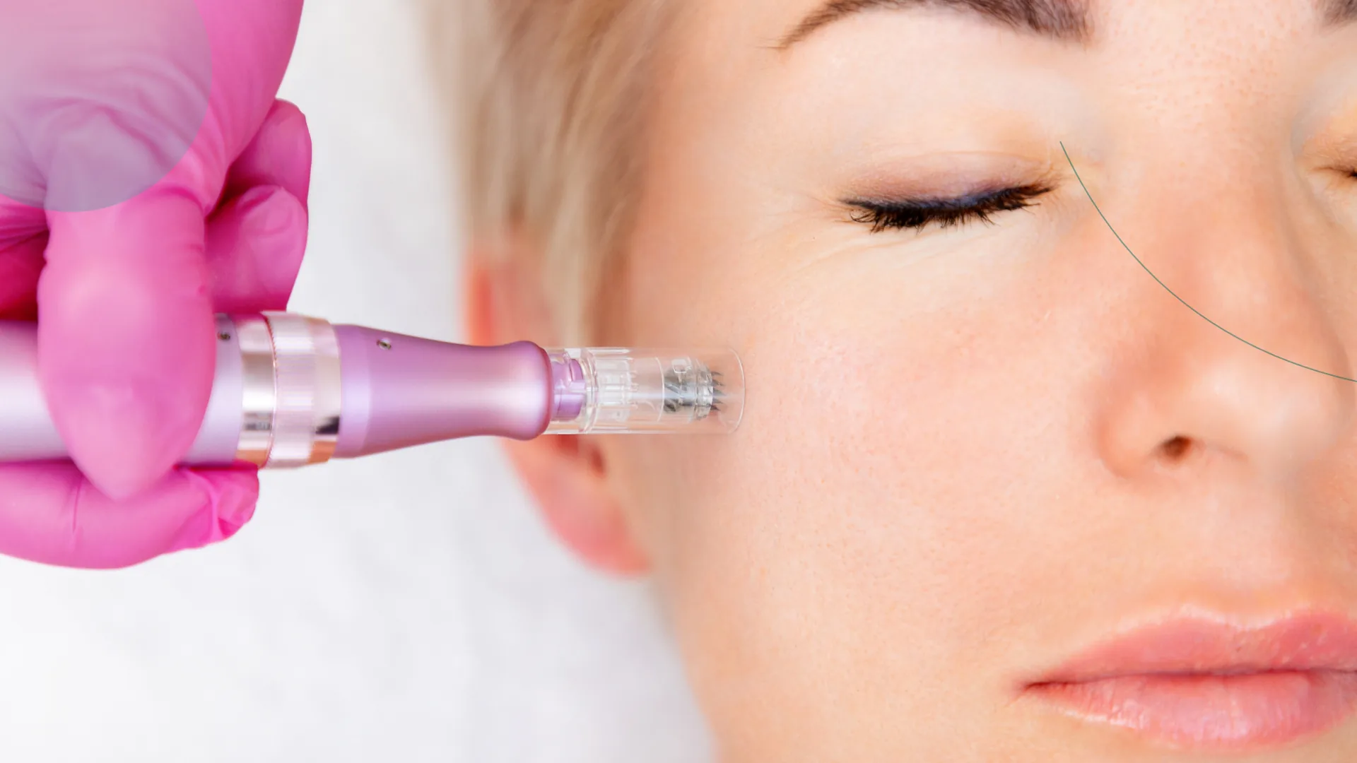 Resultados del microneedling