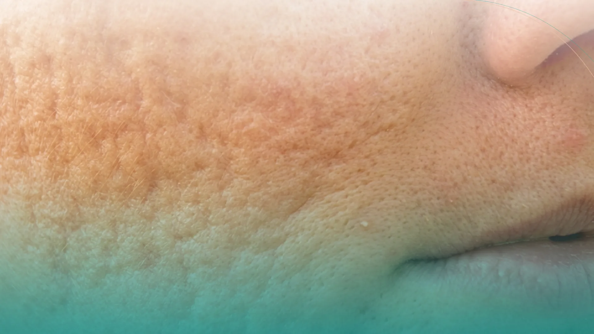 Cómo actúa el microneedling en la piel
