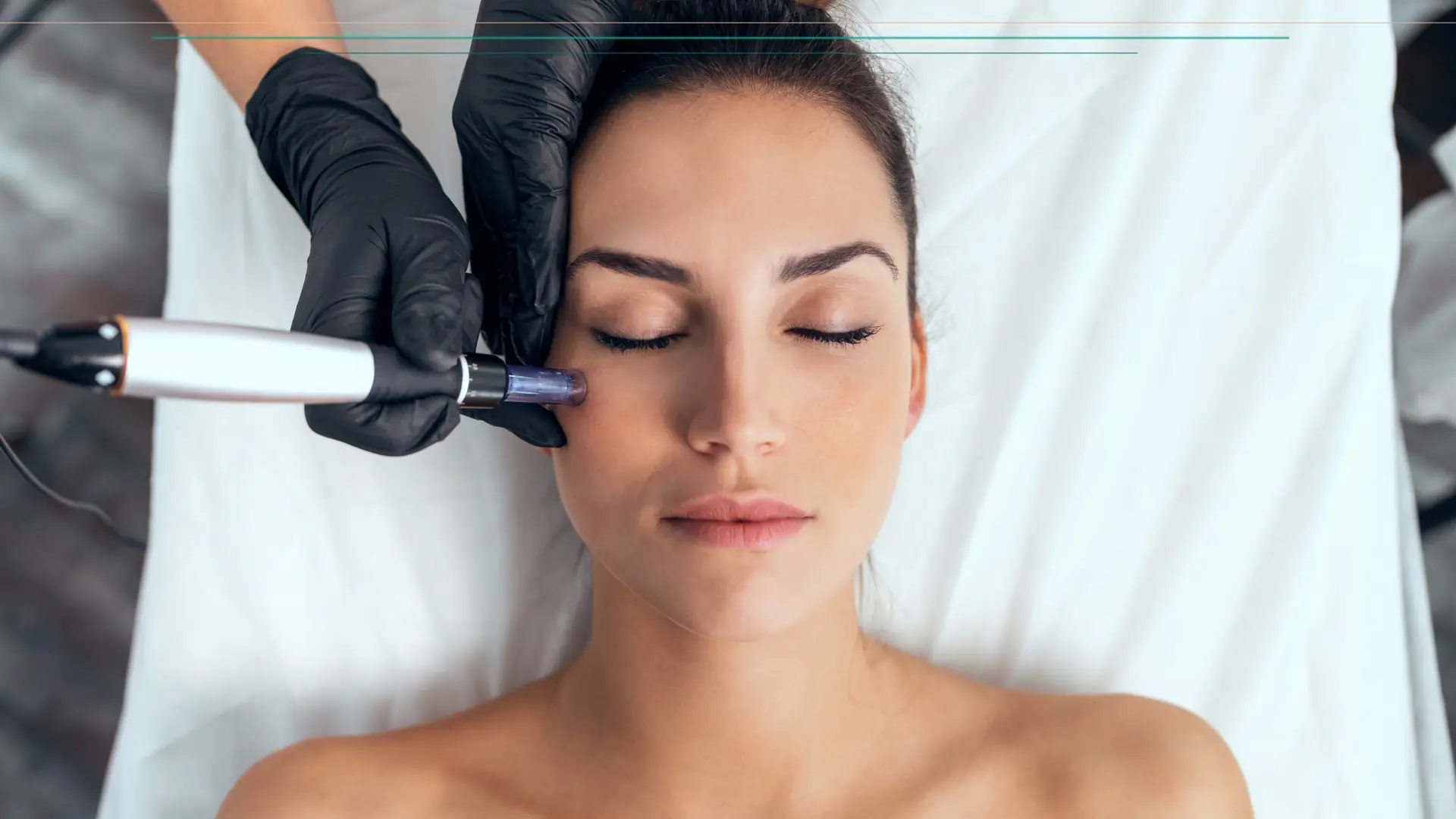 Tratamiento microneedling acne cicatrices