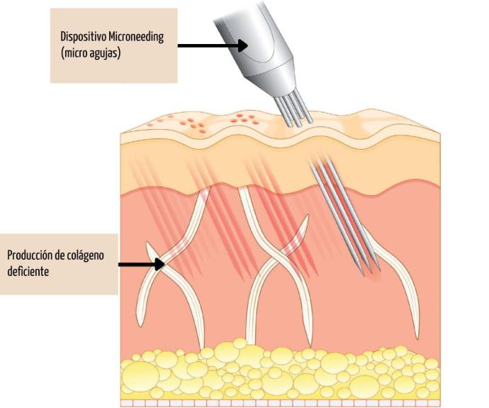 Piel envejecida con baja producción de colageno Imagen microscópica de piel antes del microneedling: colágeno disminuido, piel irregular con poros dilatados y menos elasticidad.